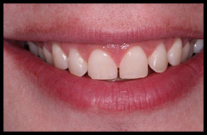 veneers_06_01
