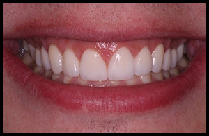 veneers_07_02
