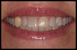 veneers_08_01