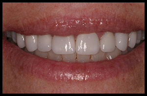 veneers_09_01