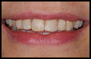 veneers_10_01