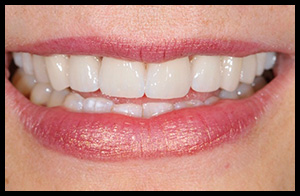veneers_11_01
